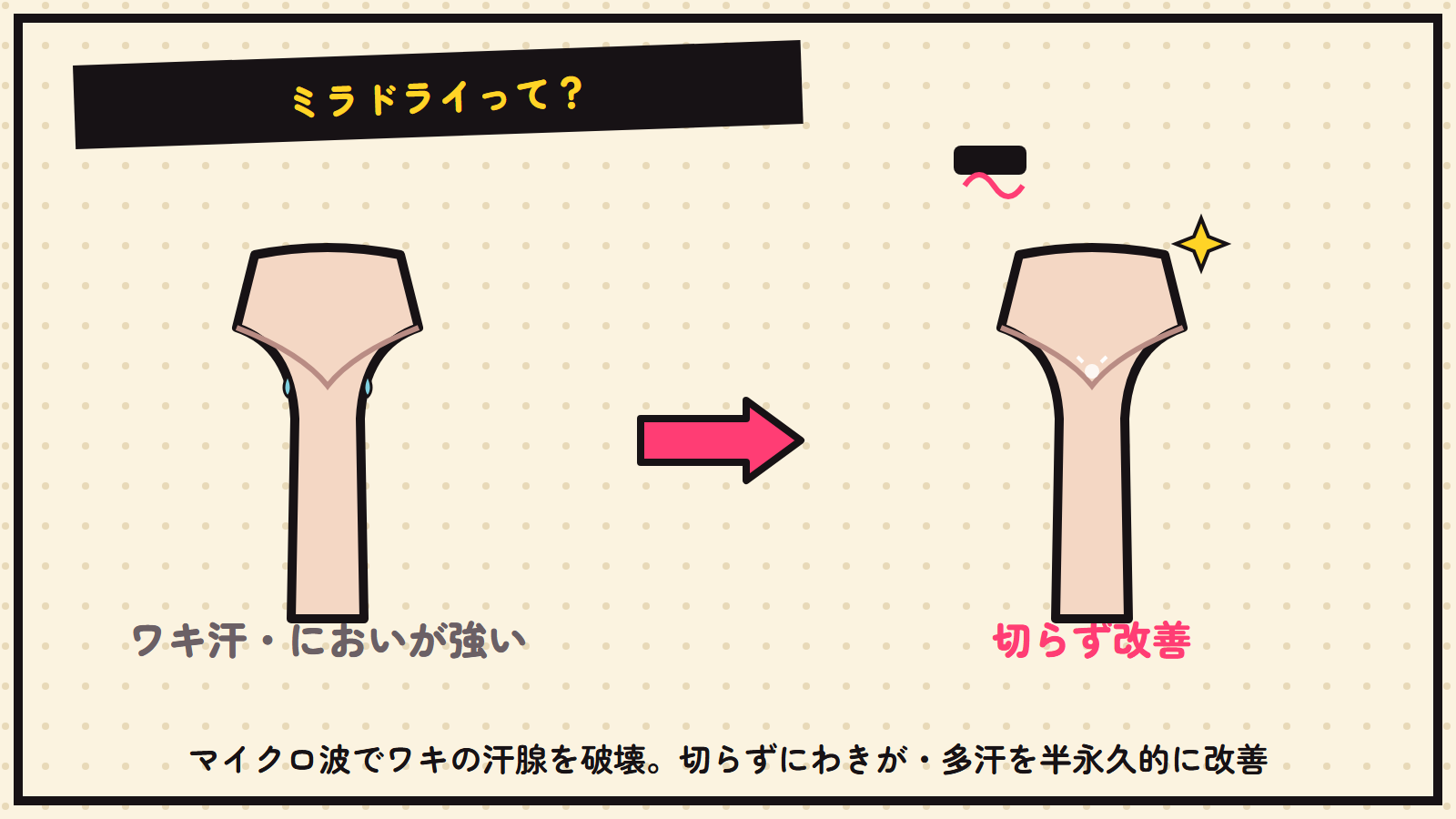 ミラドライの図解