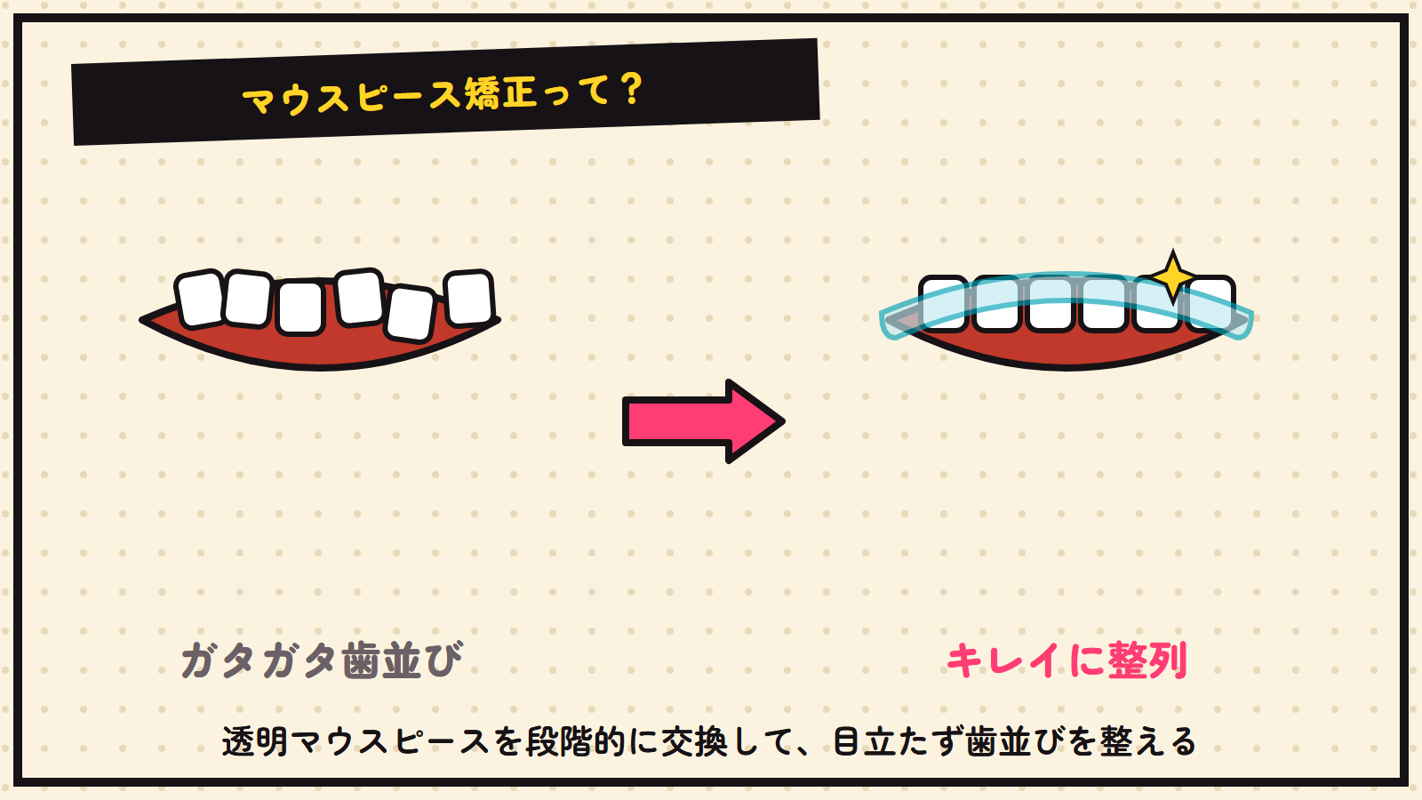 マウスピース矯正の図解