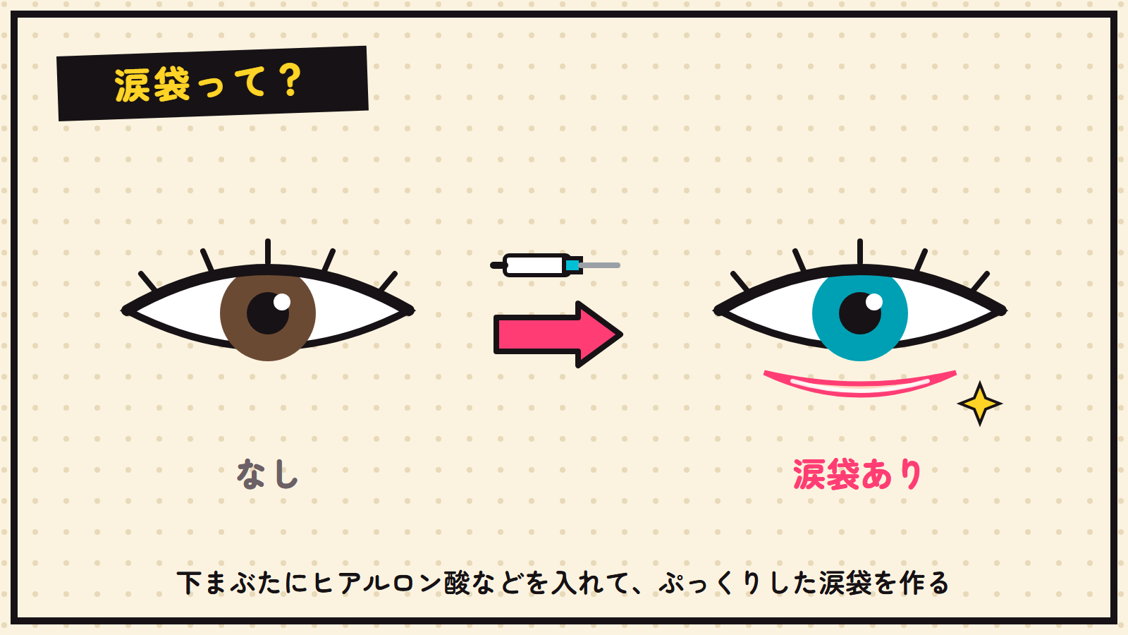 涙袋形成の図解（なし→涙袋あり）