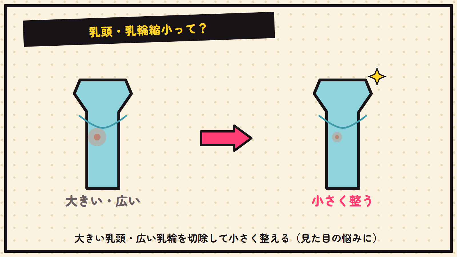 乳頭・乳輪縮小の図解（抽象）