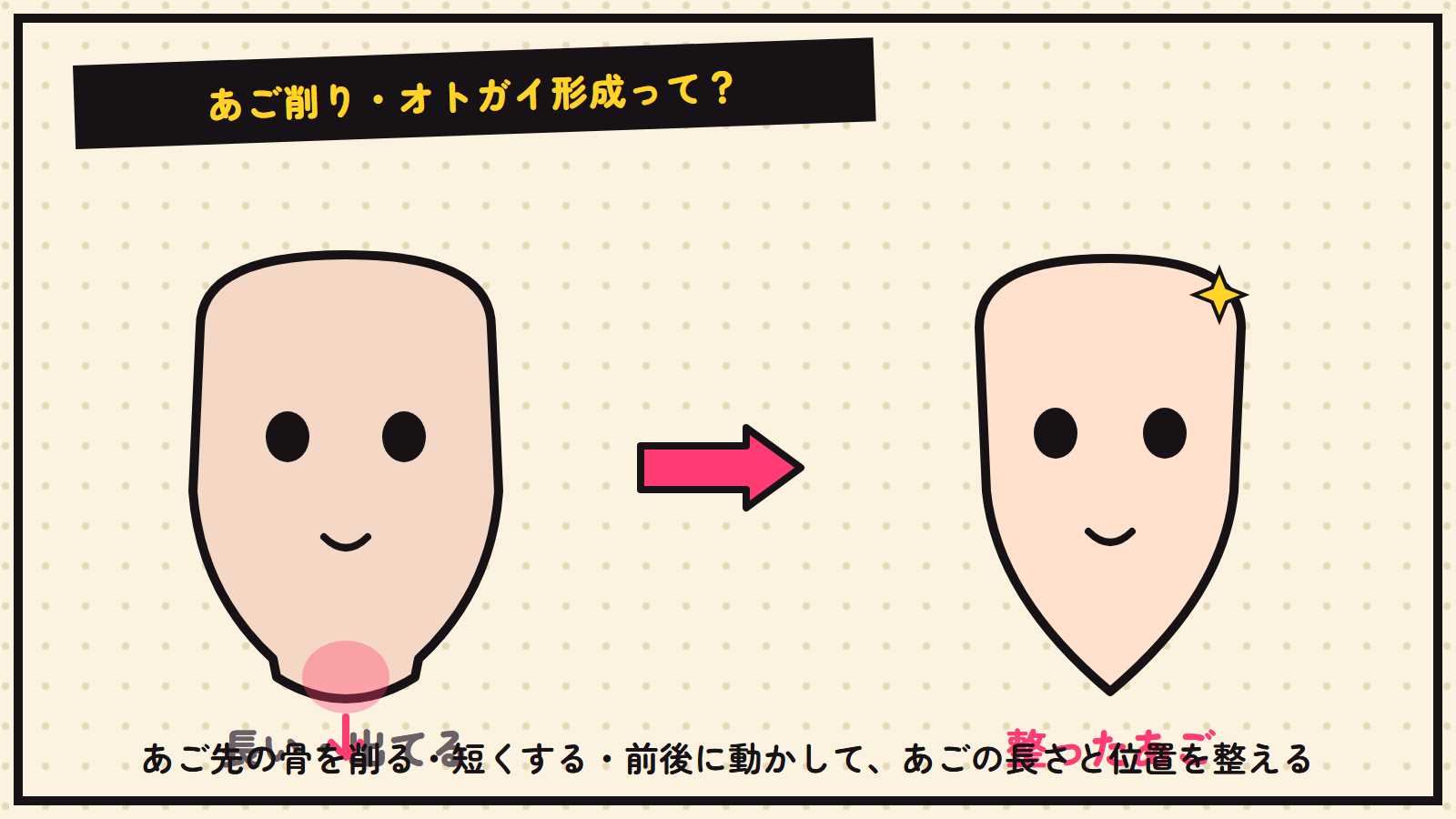 あご削り・オトガイ形成の図解