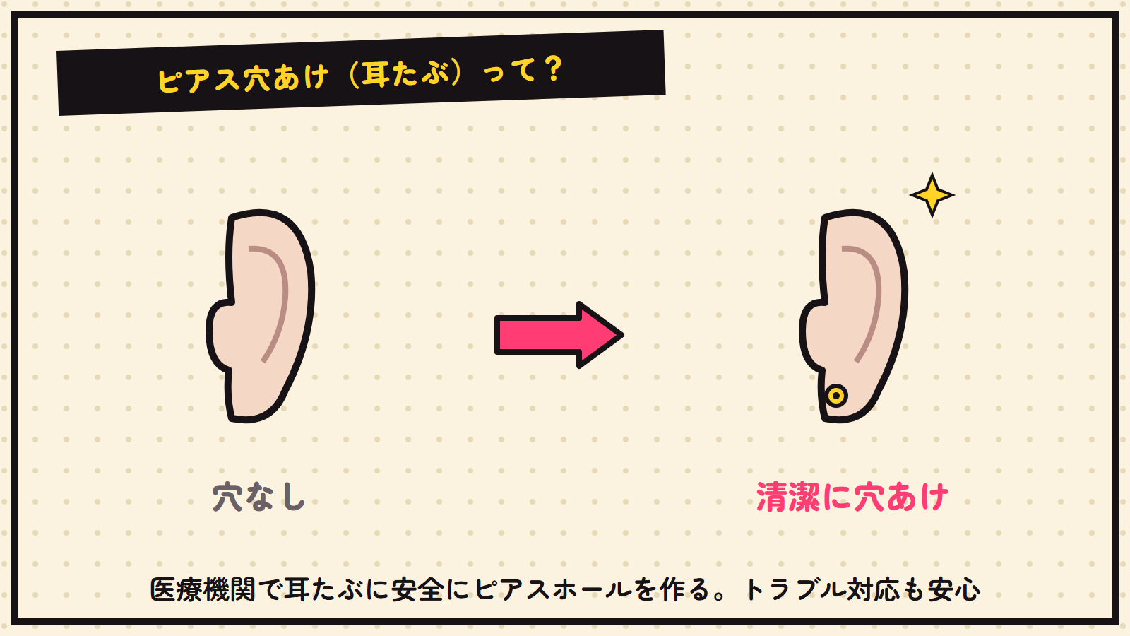 ピアス穴あけ（耳たぶ）の図解