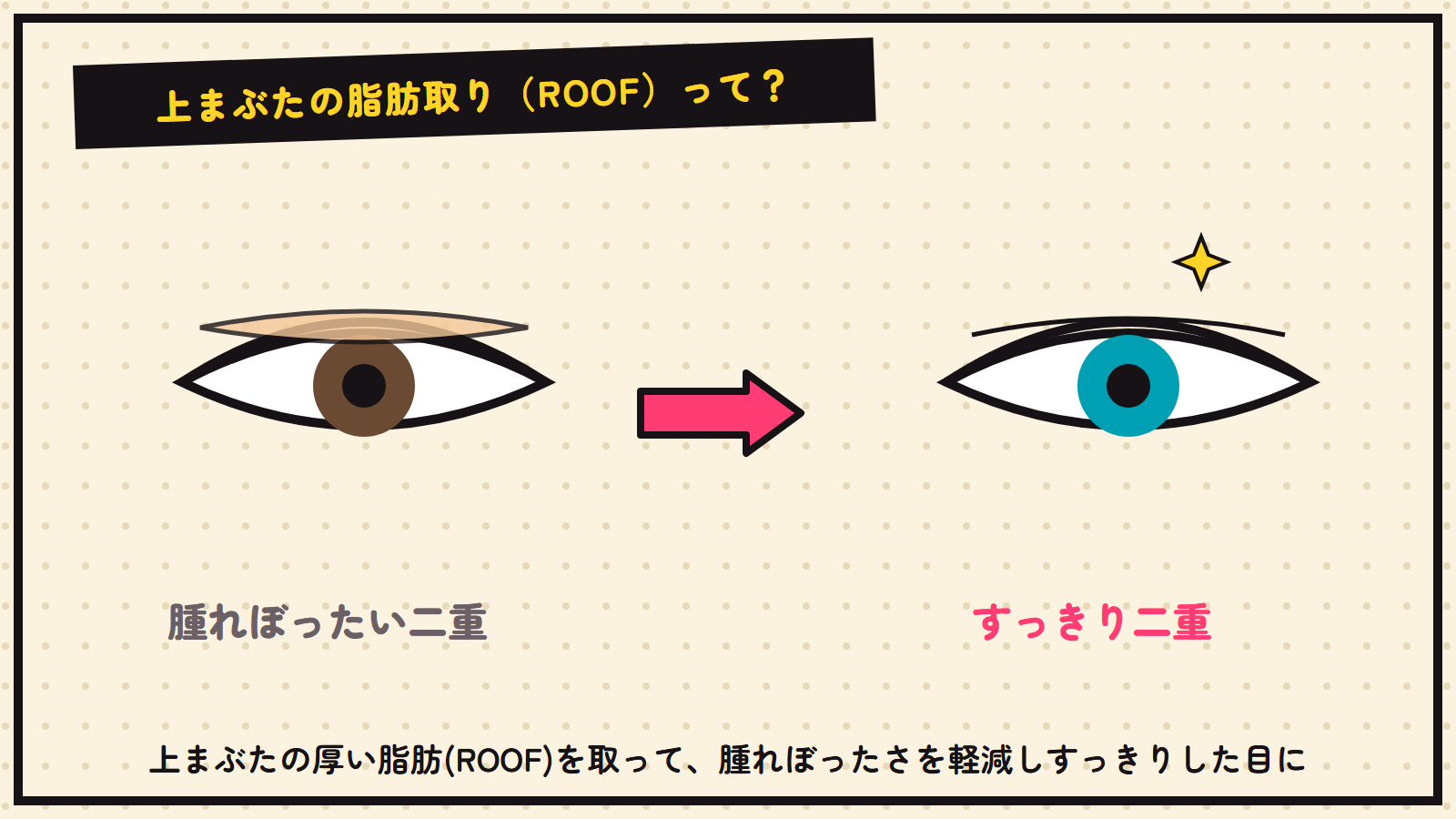 上まぶたの脂肪取り（ROOF）の図解