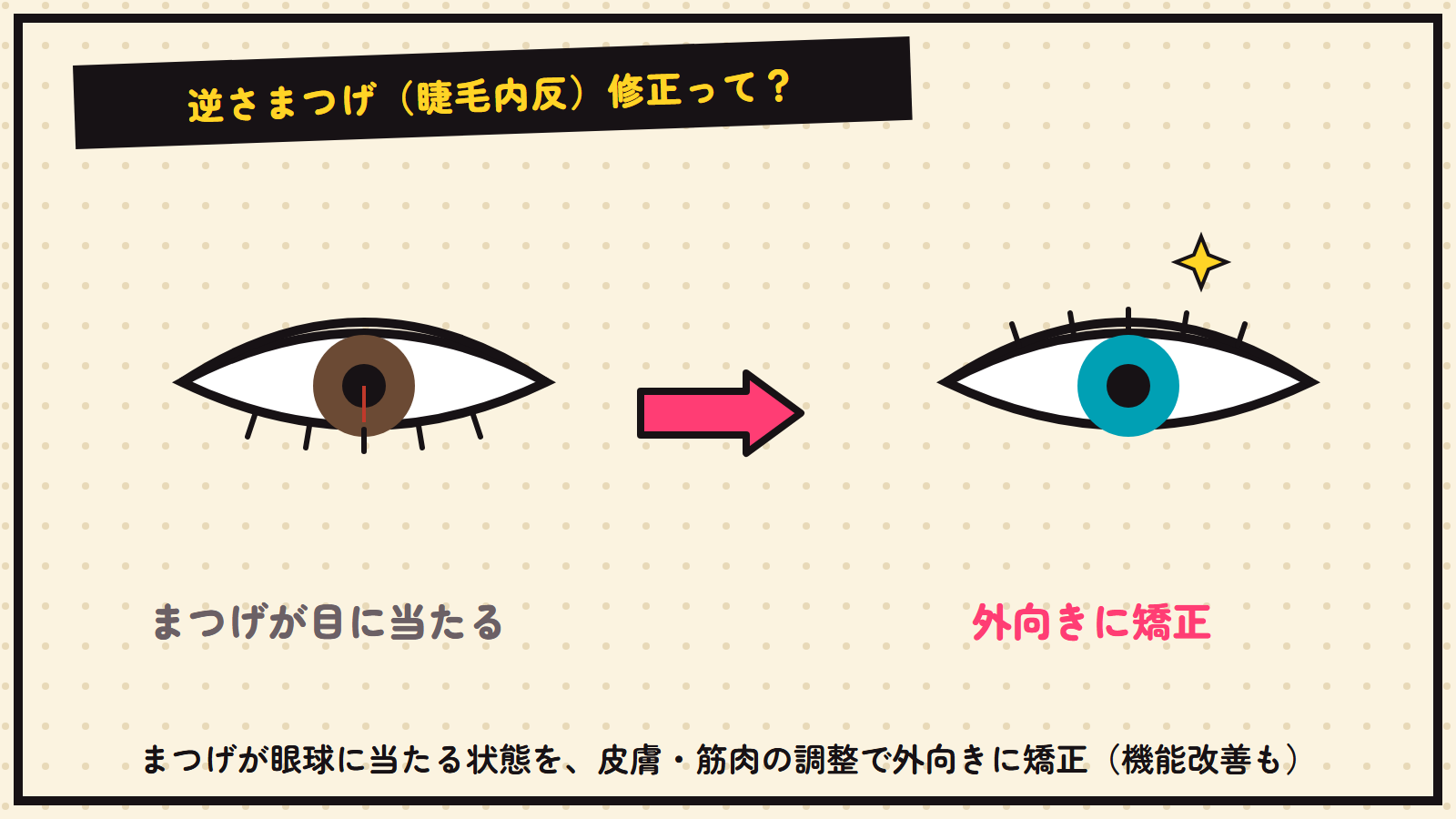 逆さまつげ修正の図解