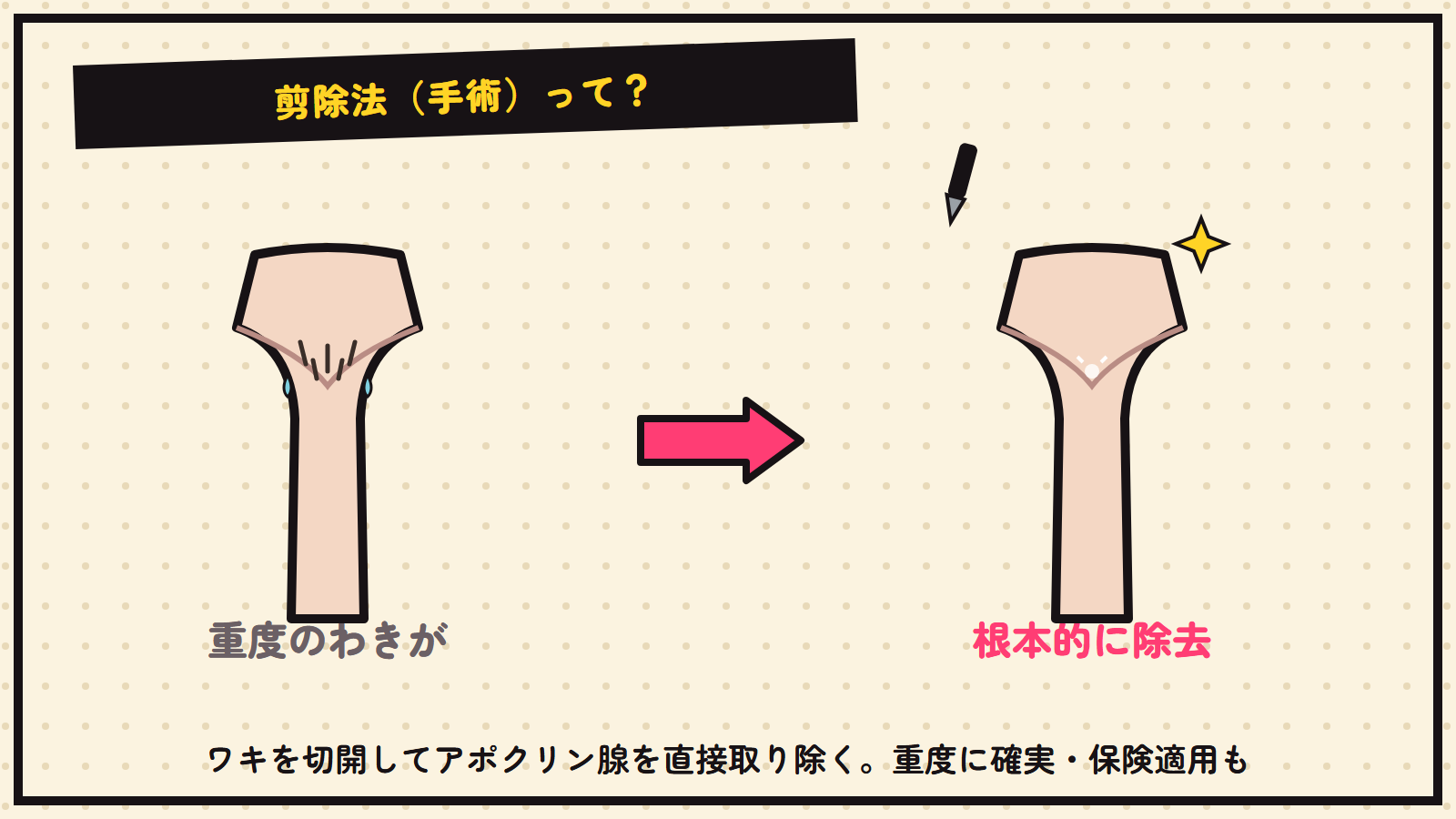 剪除法（手術）の図解