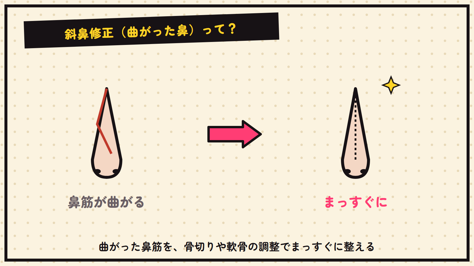 斜鼻修正の図解