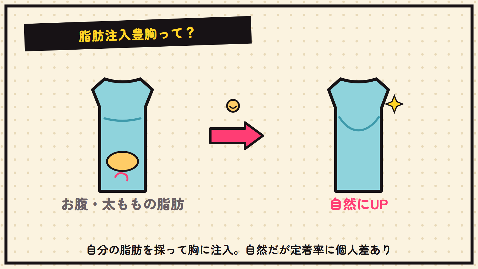 脂肪注入豊胸の図解（自分の脂肪でバストUP）
