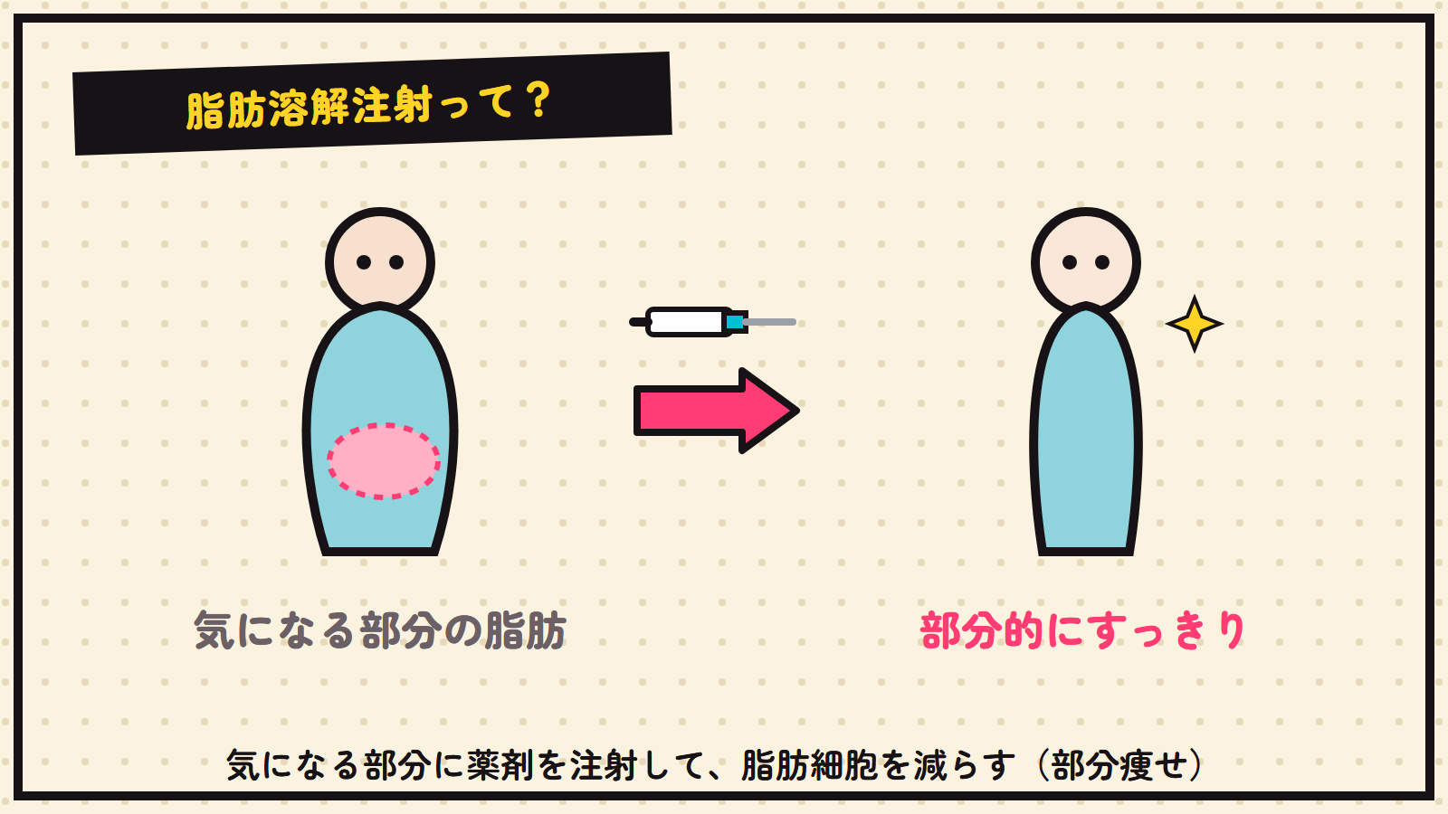 脂肪溶解注射の図解（部分的な脂肪に注射）