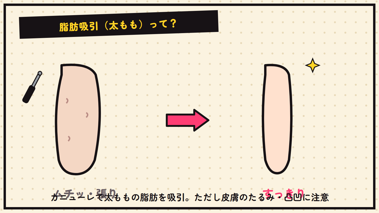 太ももの脂肪吸引の図解