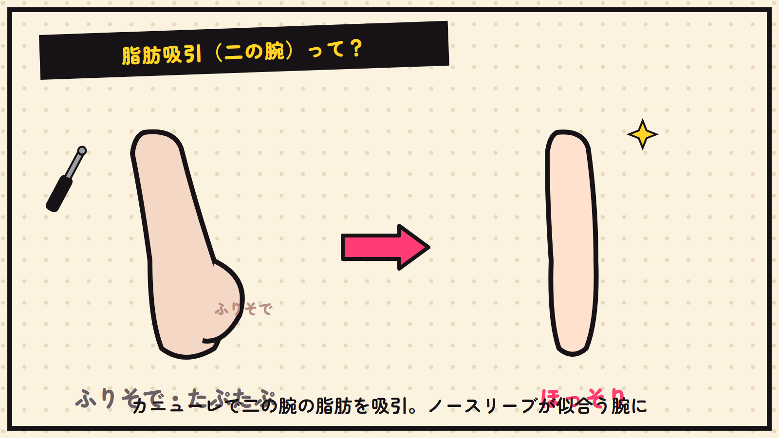 二の腕の脂肪吸引の図解