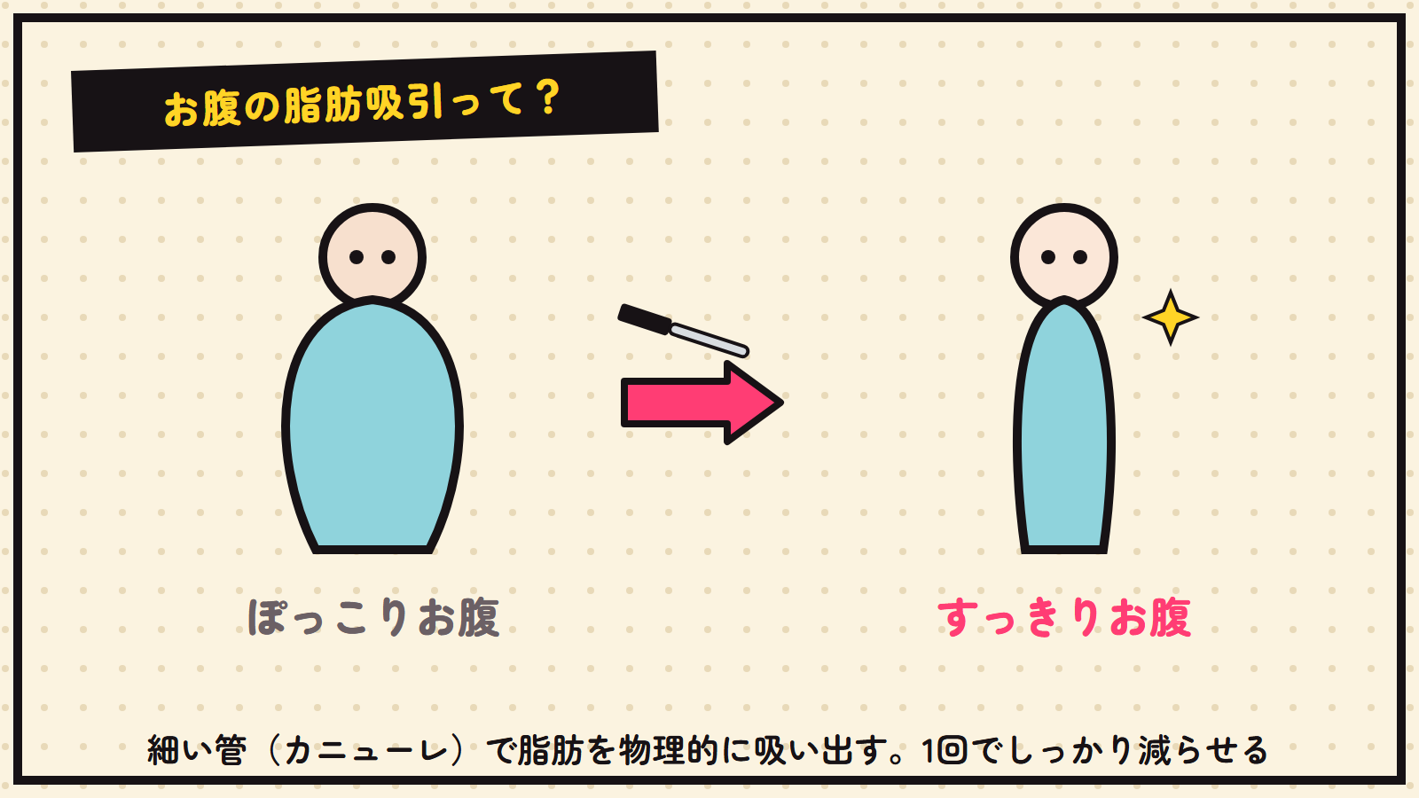 お腹の脂肪吸引の図解（カニューレで脂肪を吸引）