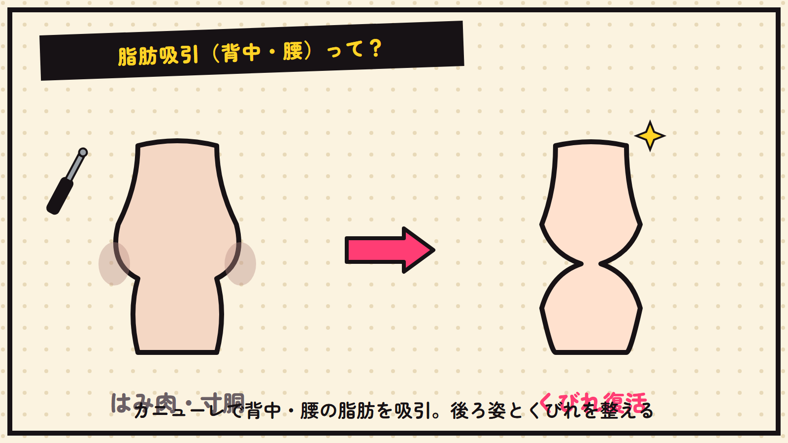 背中・腰の脂肪吸引の図解