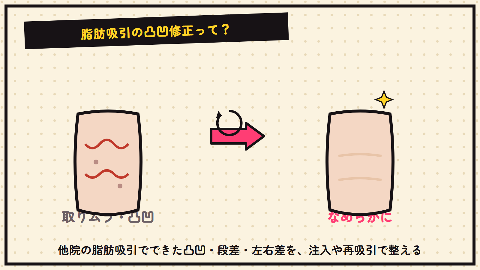 脂肪吸引の凸凹修正の図解