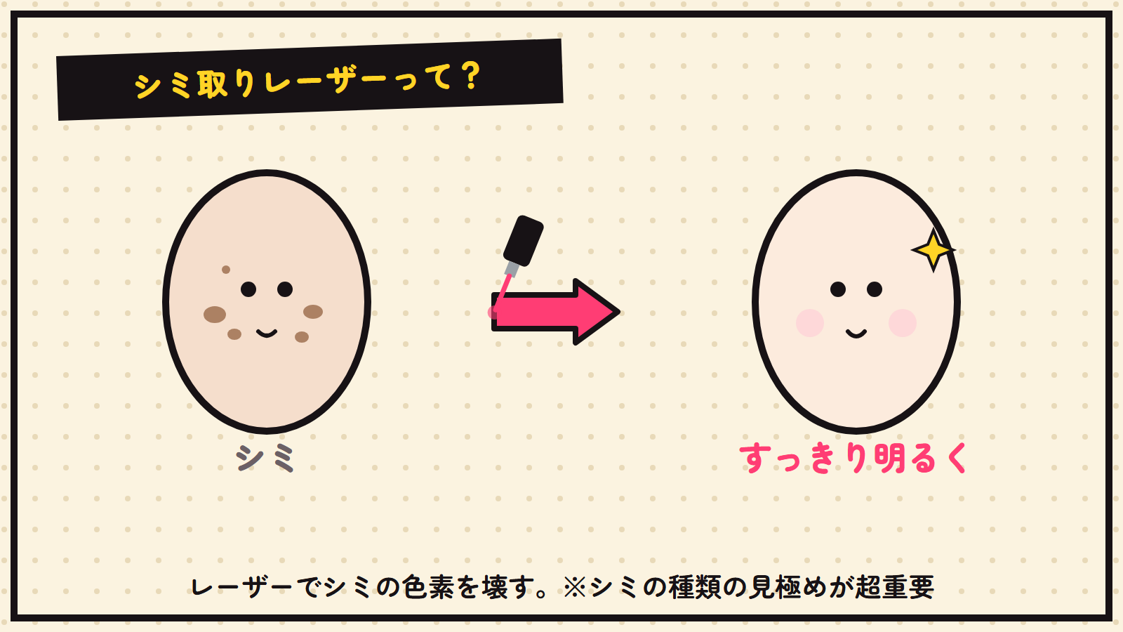 シミ取りレーザーの図解（シミ→すっきり）