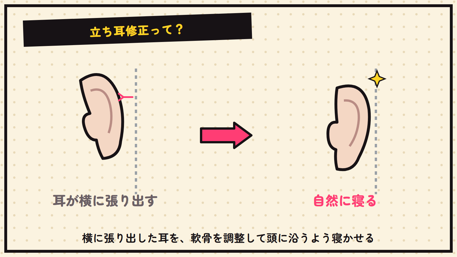 立ち耳修正の図解