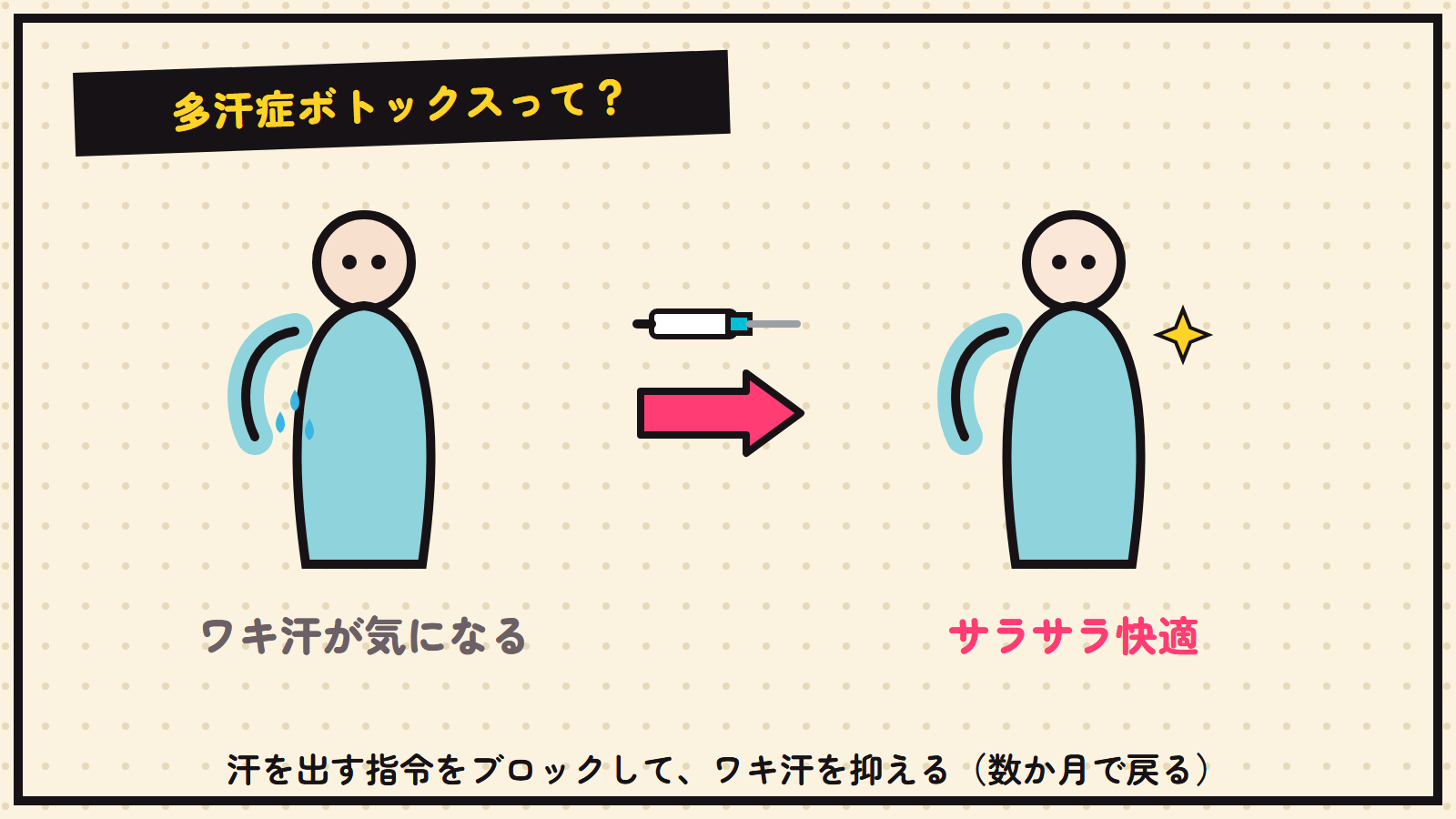 多汗症ボトックスの図解（ワキ汗を抑える）