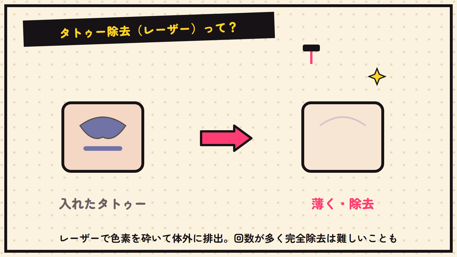 タトゥー除去の図解