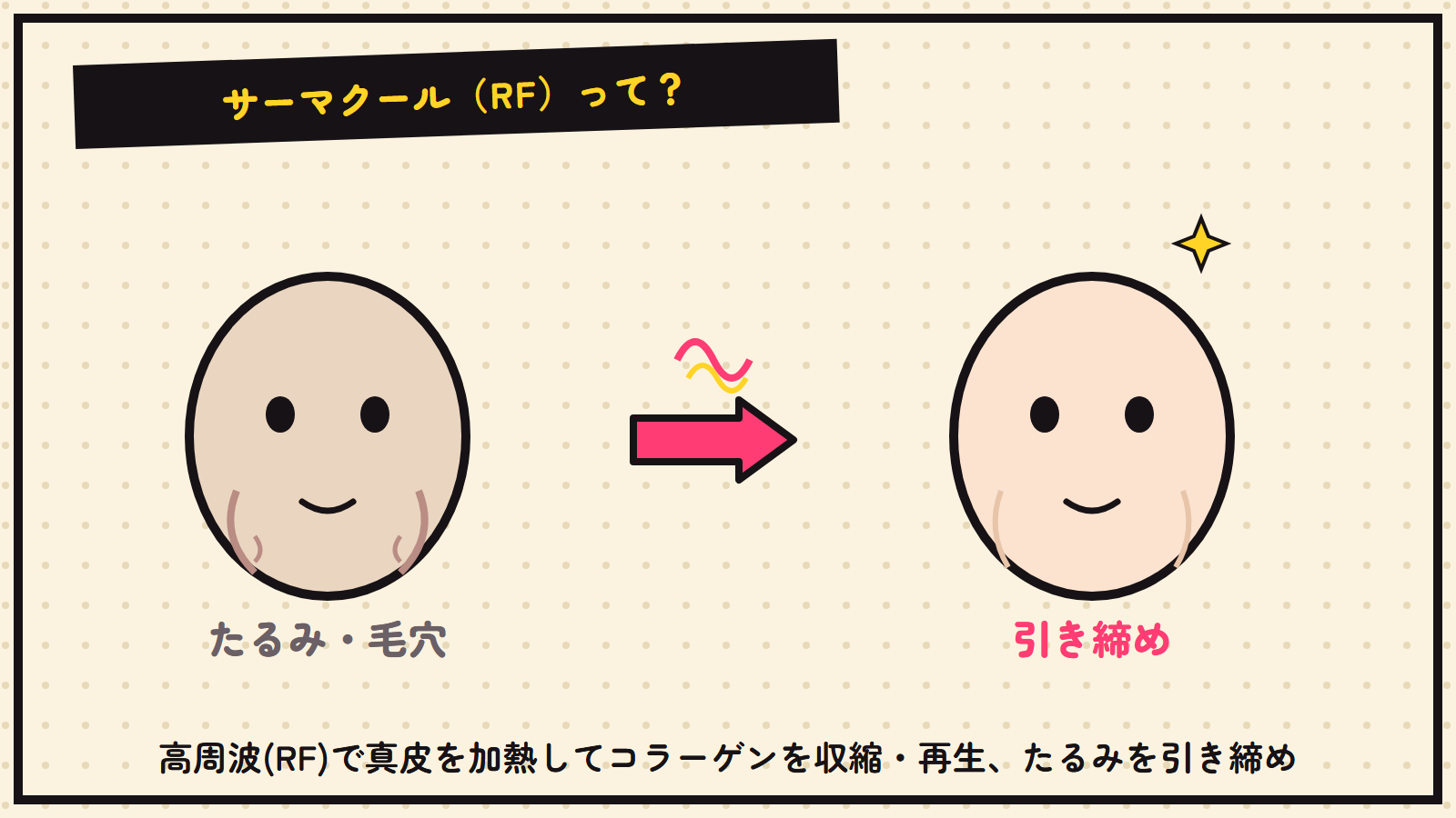 サーマクール（RF）の図解