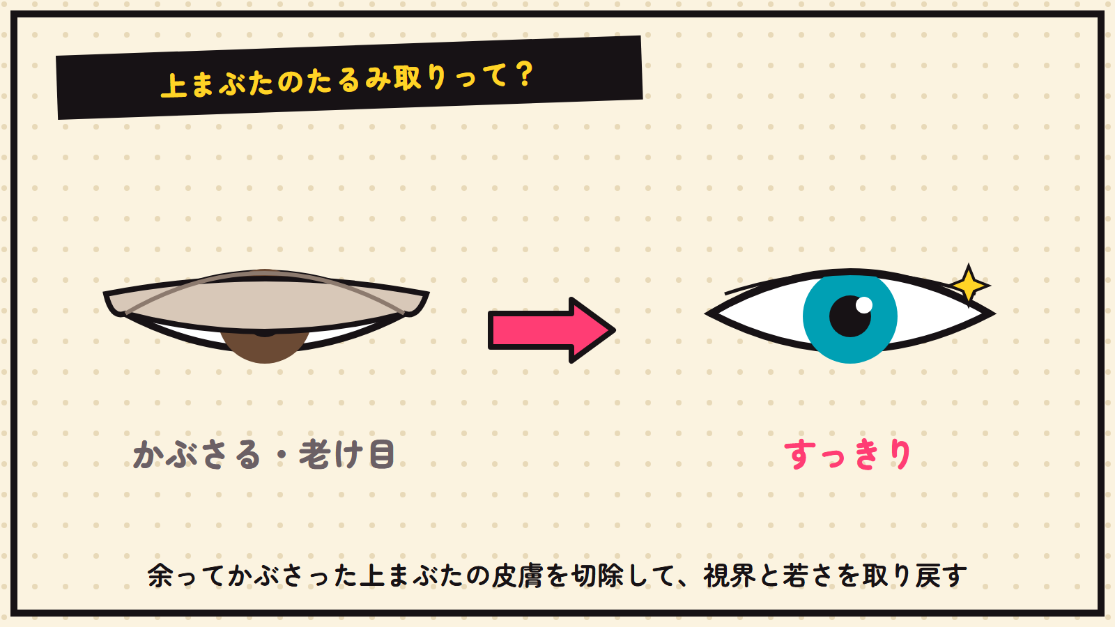 上まぶたのたるみ取りの図解