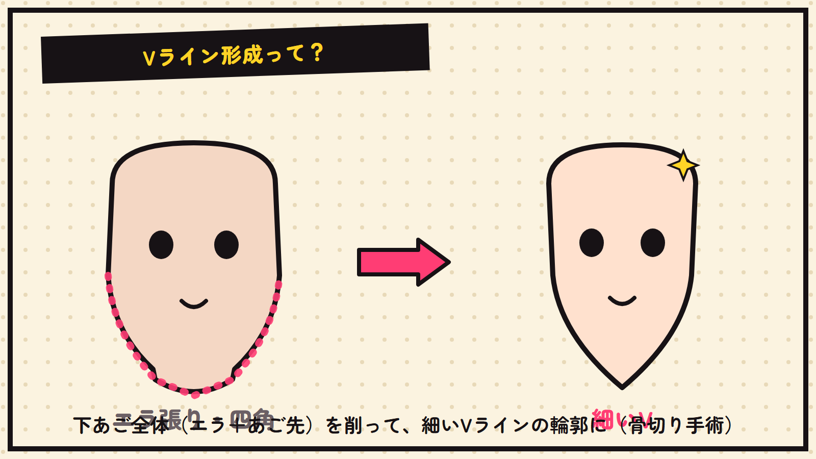Vライン形成の図解（下あごを細く）