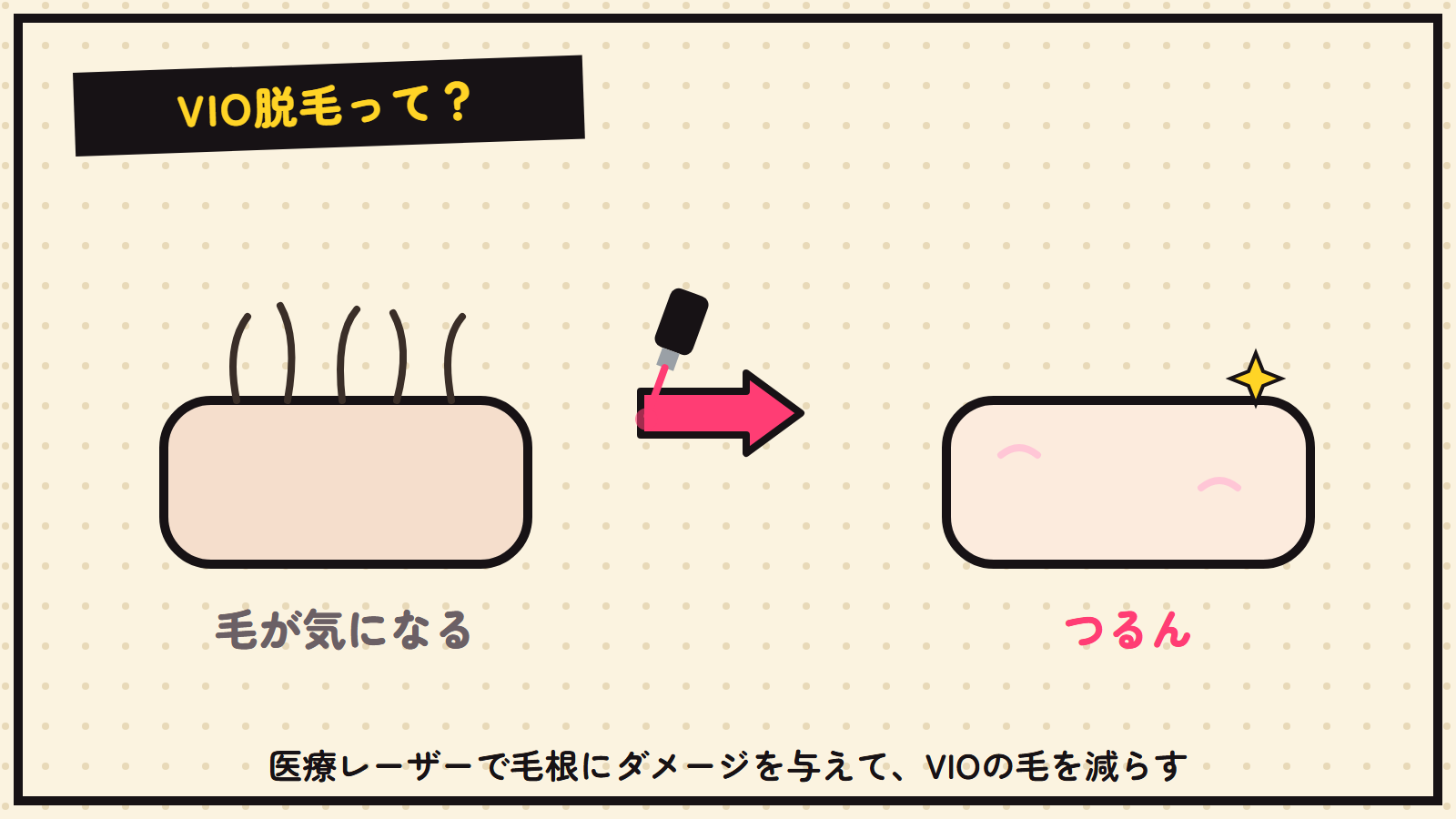 VIO脱毛の図解（医療レーザーで毛を減らす）