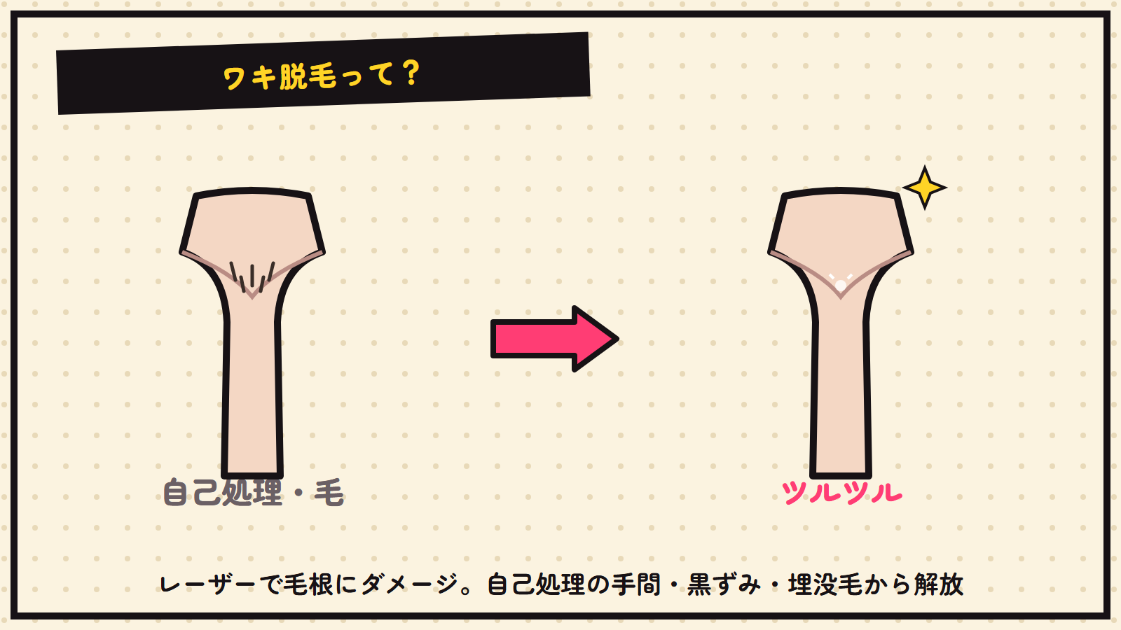 ワキ脱毛の図解