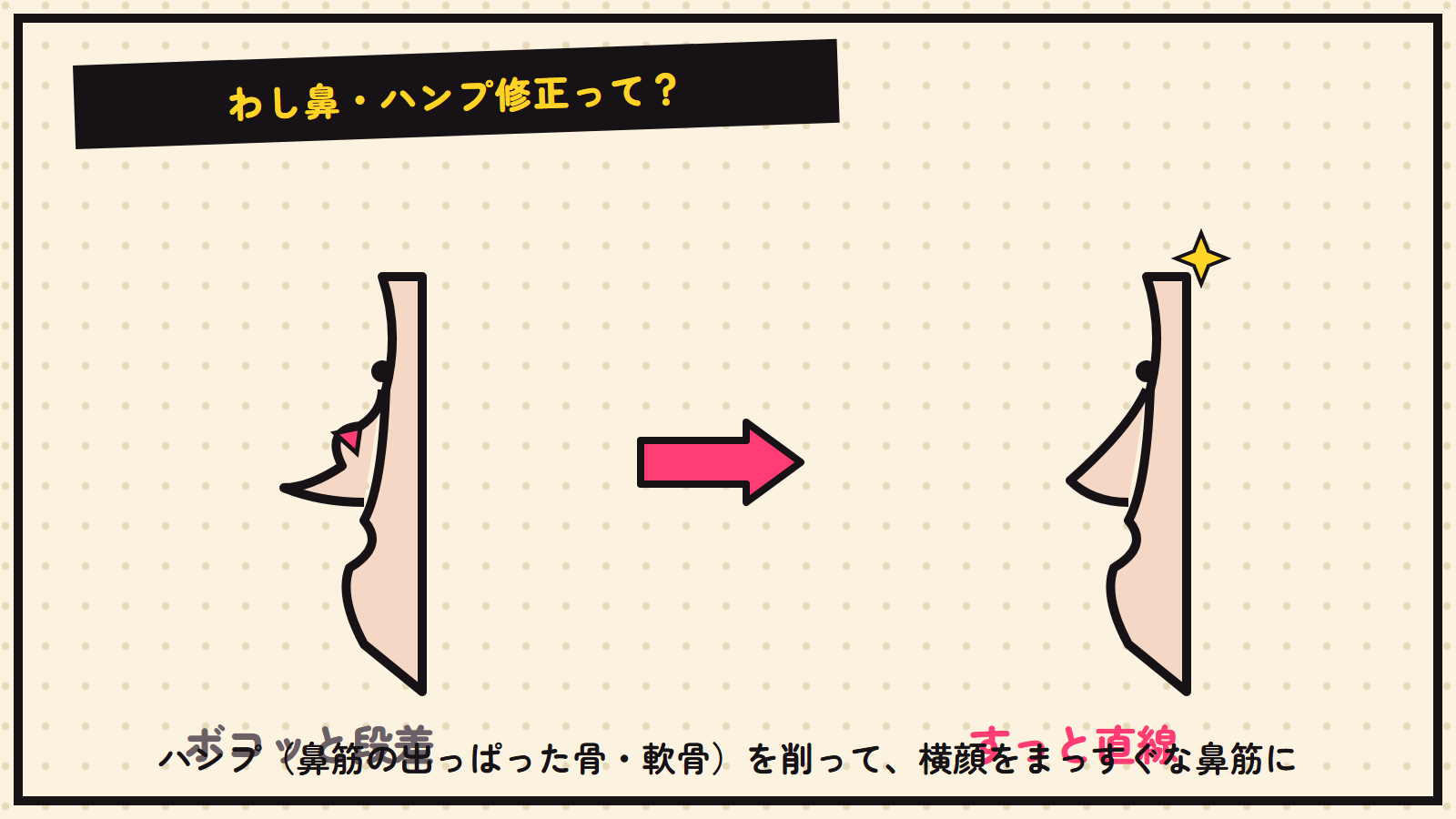 わし鼻・ハンプ修正の図解（横顔の段差を取る）