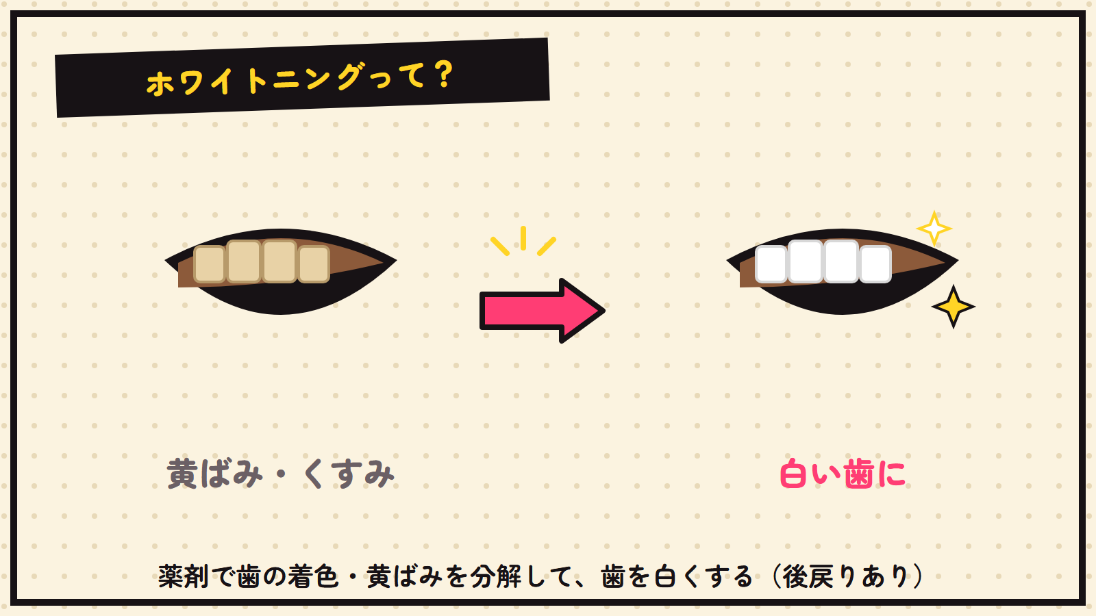 歯のホワイトニングの図解（黄ばみ→白い歯）