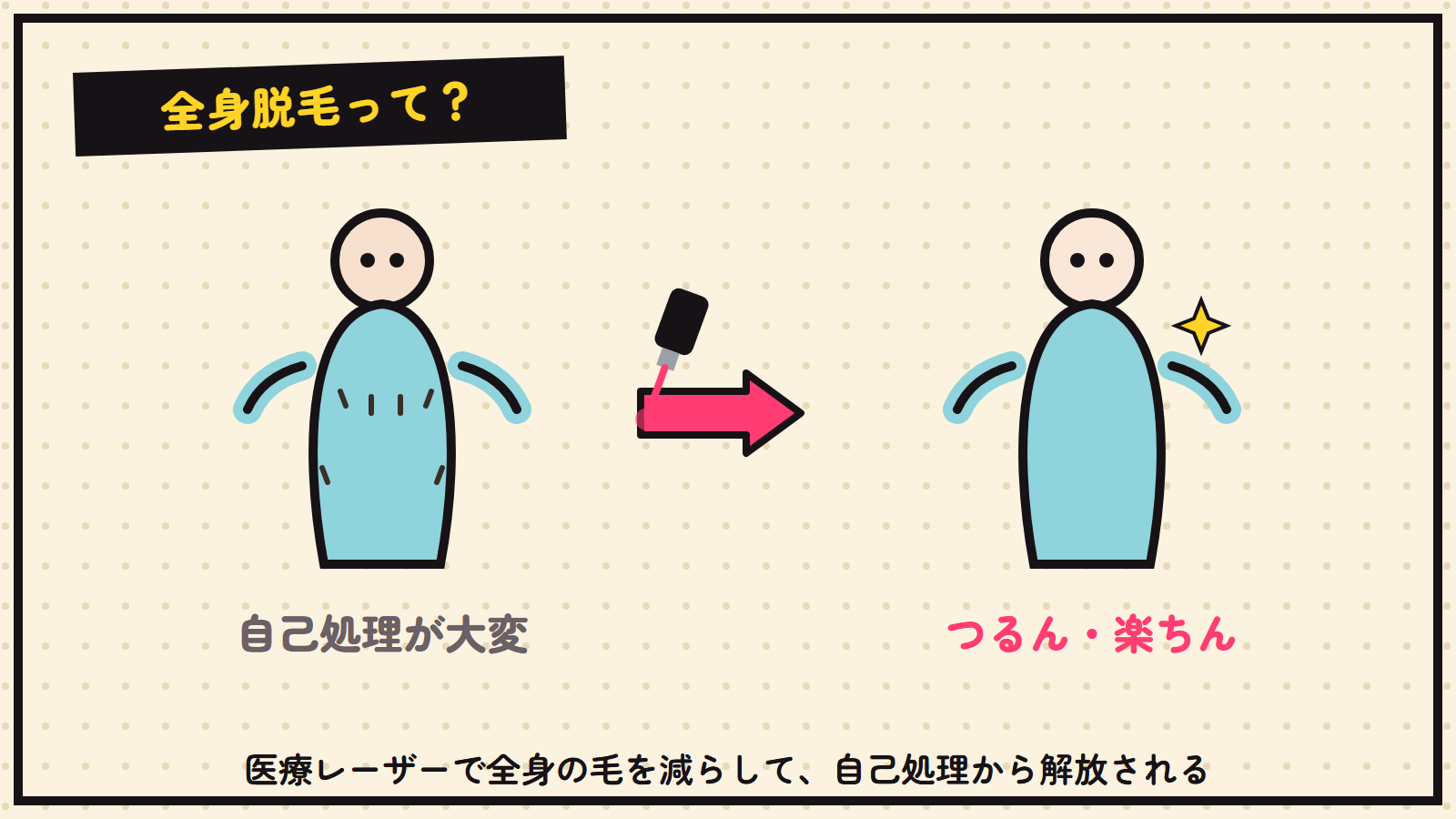 全身脱毛の図解（医療レーザーで全身の毛を減らす）